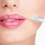 lip reshaping surgery