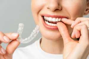 best aligners for teeth