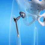hip joint replacement surgery