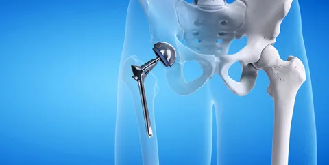 hip joint replacement surgery